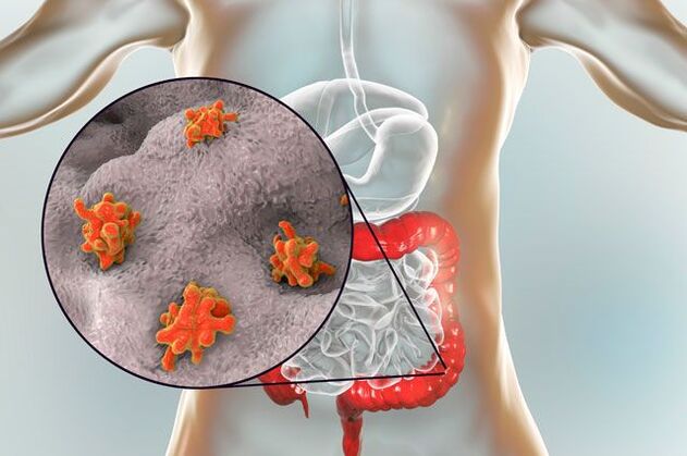 Tipuri de paraziți în corpul uman