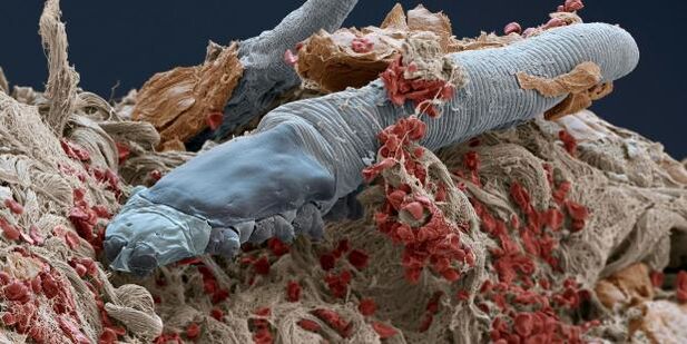 acarian demodex